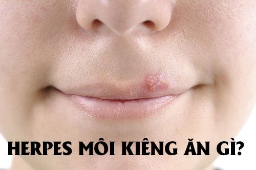 Herpes môi kiêng ăn gì