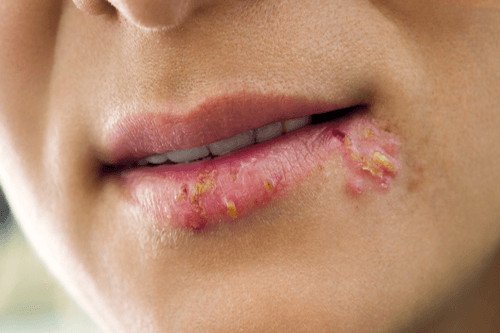 Herpes môi là gì? Herpes môi kiêng ăn gì để mau khỏi bệnh?